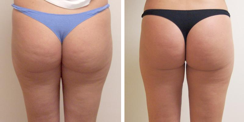 Luxury Cellulite Cream